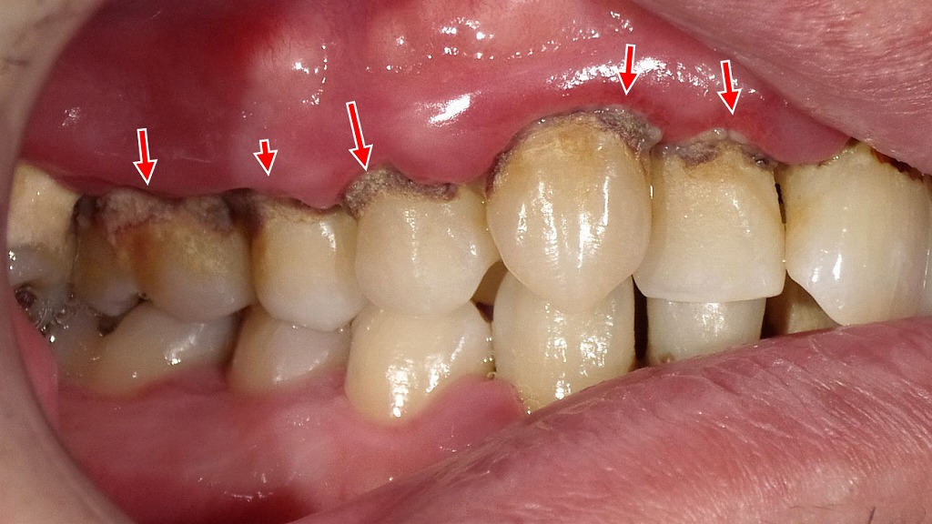 歯周病とアルツハイマー型認知症の関係とは？