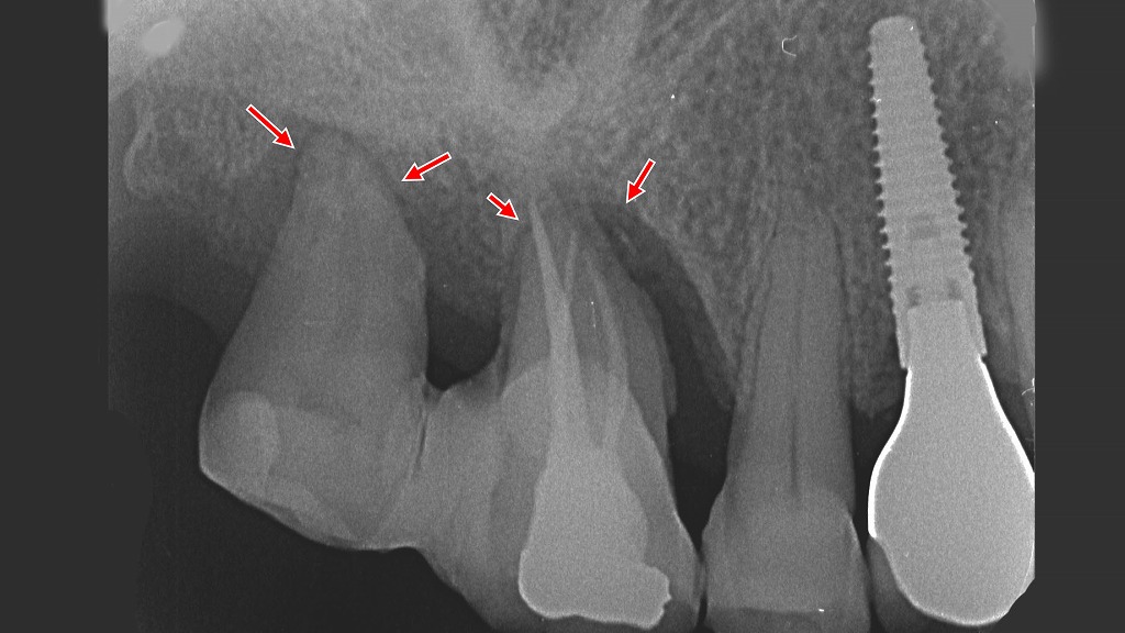 プラークが進行させた重度歯周病｜6・7番の歯槽骨吸収と治療選択