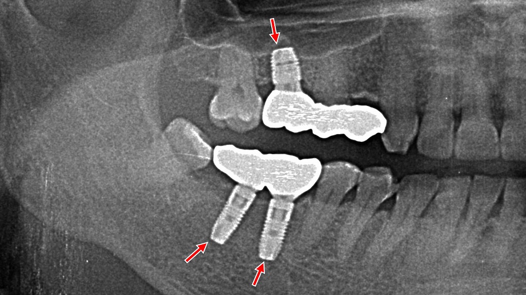 下顎は6・7番、上顎6番相当部にインプラント