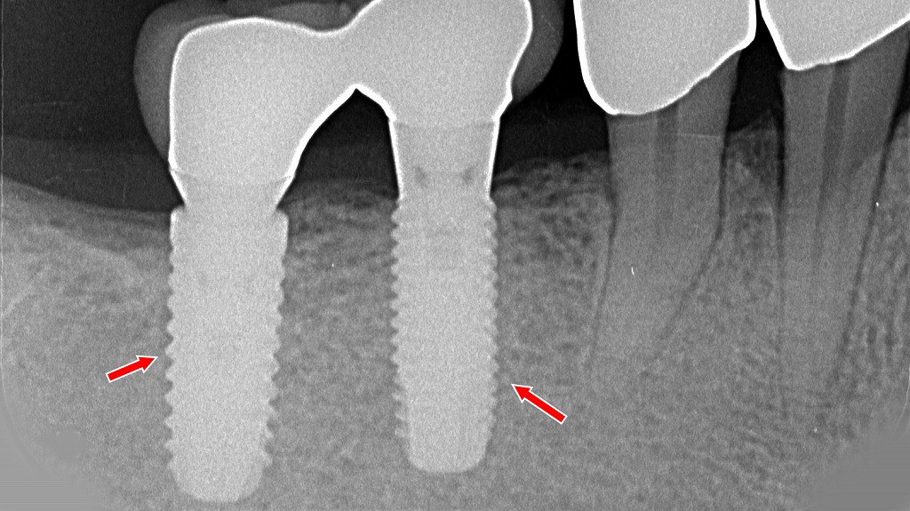 6番・7番相当部に埋入したインプラントのX線所見
