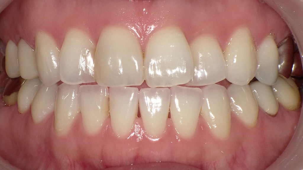 ホワイトニング術後