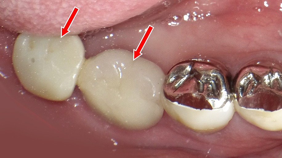 フルジルコニアクラウンで補綴したインプラント(6番・7番相当部)