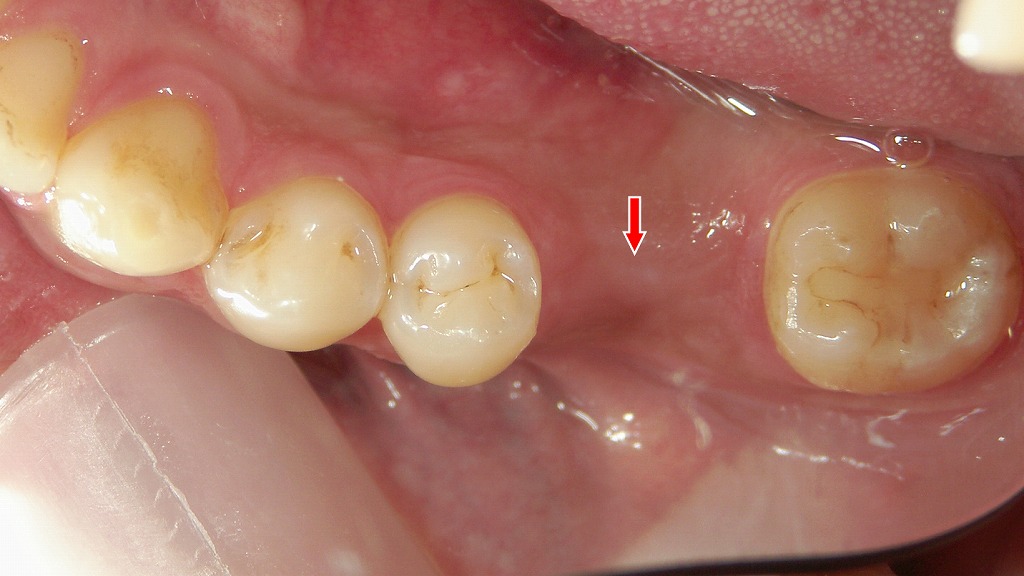 下顎6番欠損に対するインプラント治療