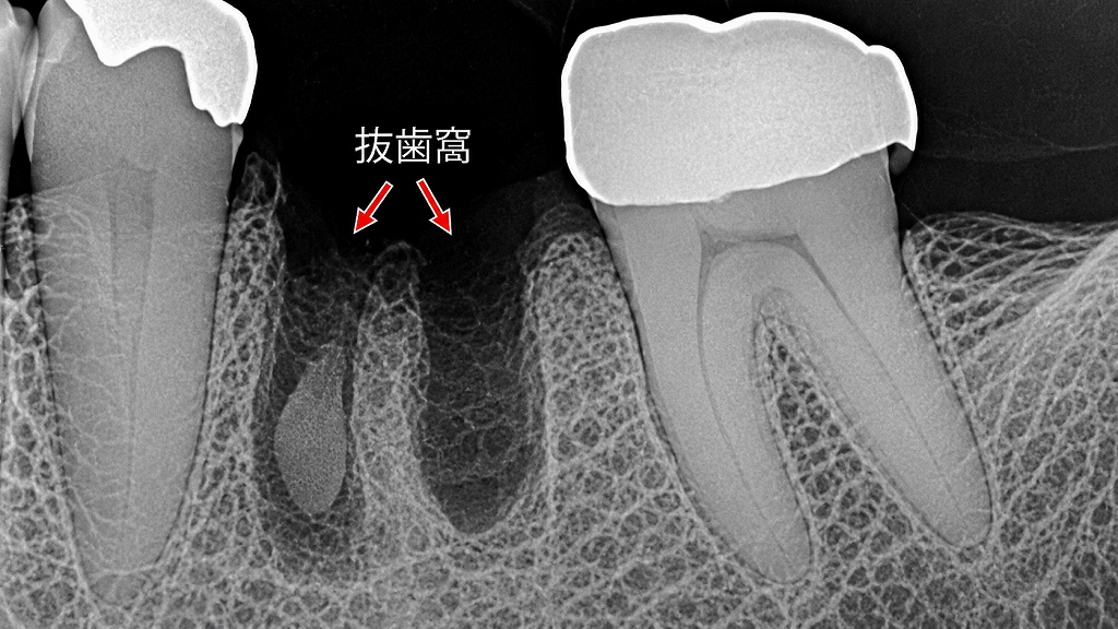 抜歯窩