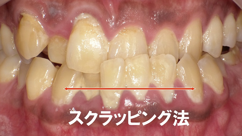 下顎前歯の歯頚部に付着した歯垢・歯石の症例
