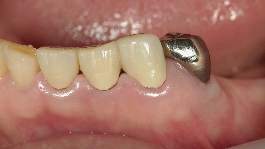 腫れと出血が消えた健康な歯肉の状態