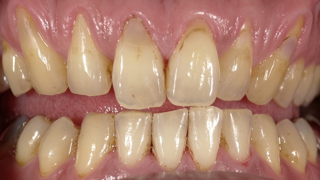 【After（エアフロー後）】