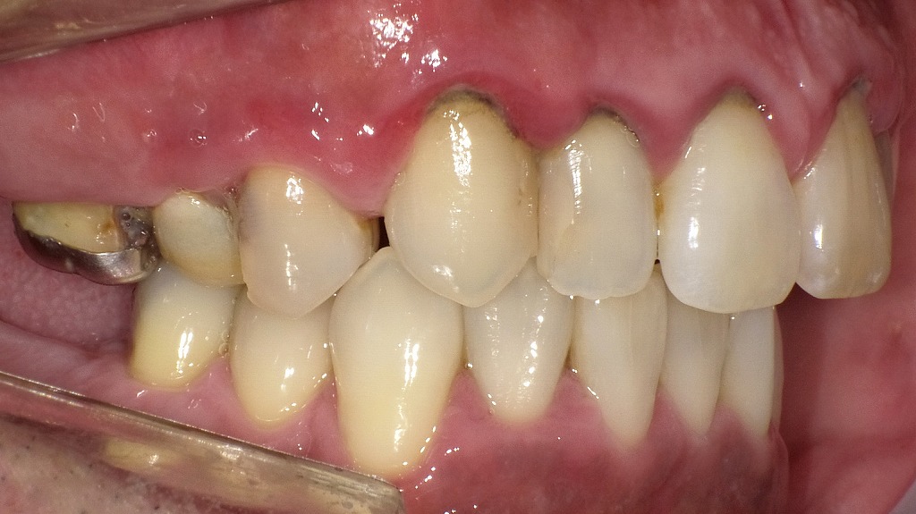 重度歯周病:右側面