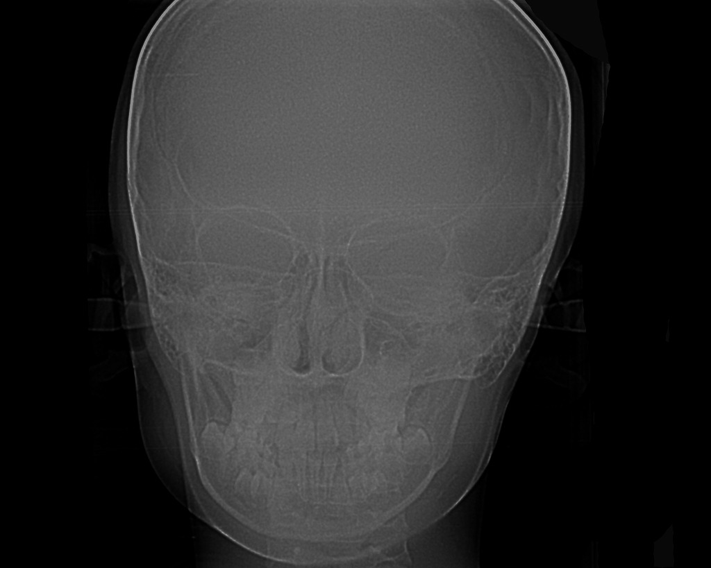 セファロレントゲン（正面）