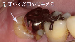 斜めに生えた親知らずが招くトラブル|隣の歯の虫歯リスクが上昇