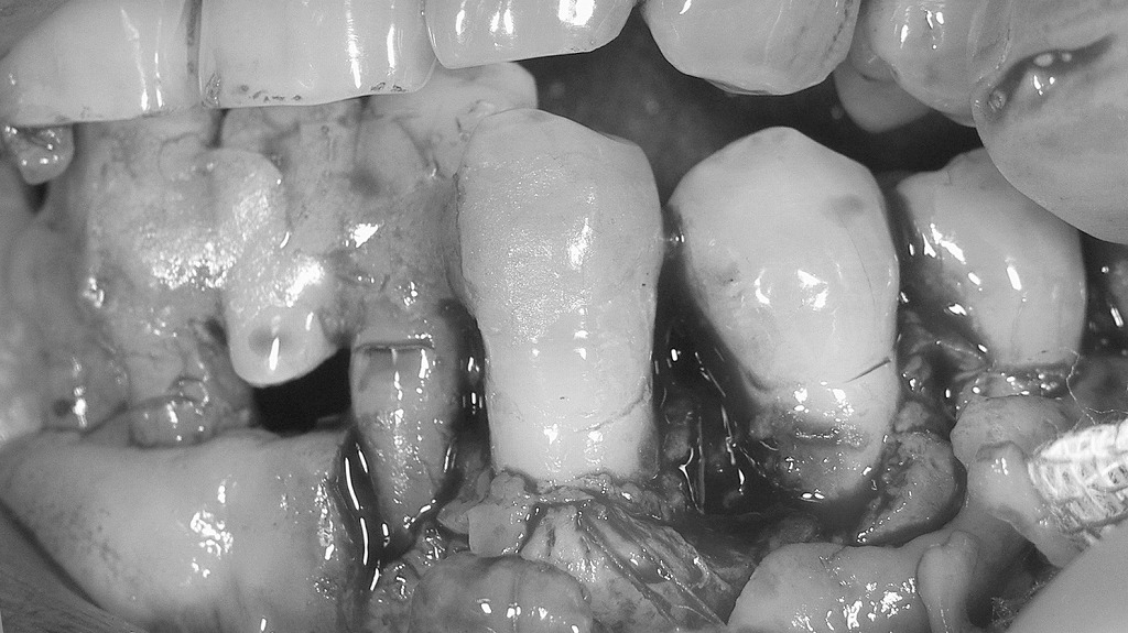 フラップ手術により歯肉を開き、根面の歯石・感染組織を徹底的に除去した状態。歯周ポケット内部が清潔になり、治癒が進む環境が整った。