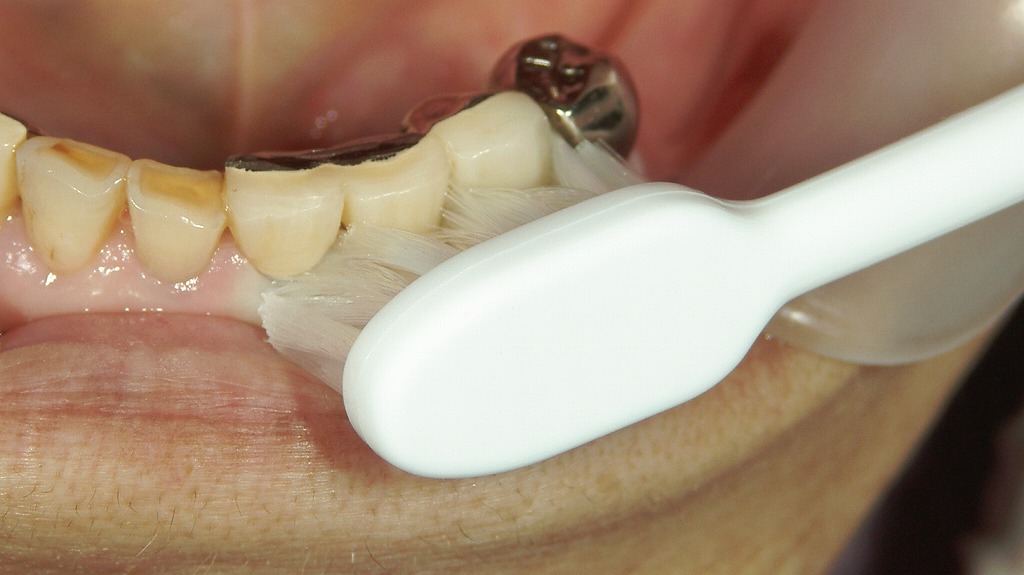 45度の角度で歯肉溝を清掃するバス法の実践