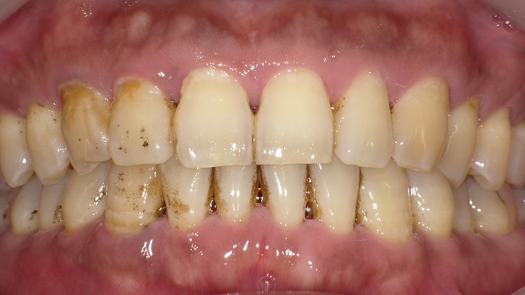 デンタルフロスが必要な理由：歯間に潜む歯垢が招く歯周病リスク