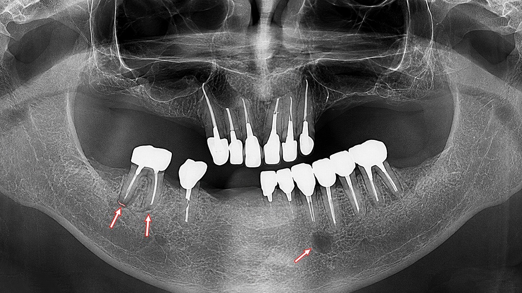 根尖病巣（歯根嚢胞）の有無を確認：下顎6番と3番に根尖病巣（黒く写る）を認める