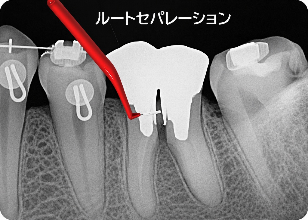 下顎6番に2歯分の金属冠を装着、歯間ブラシが通るようにする