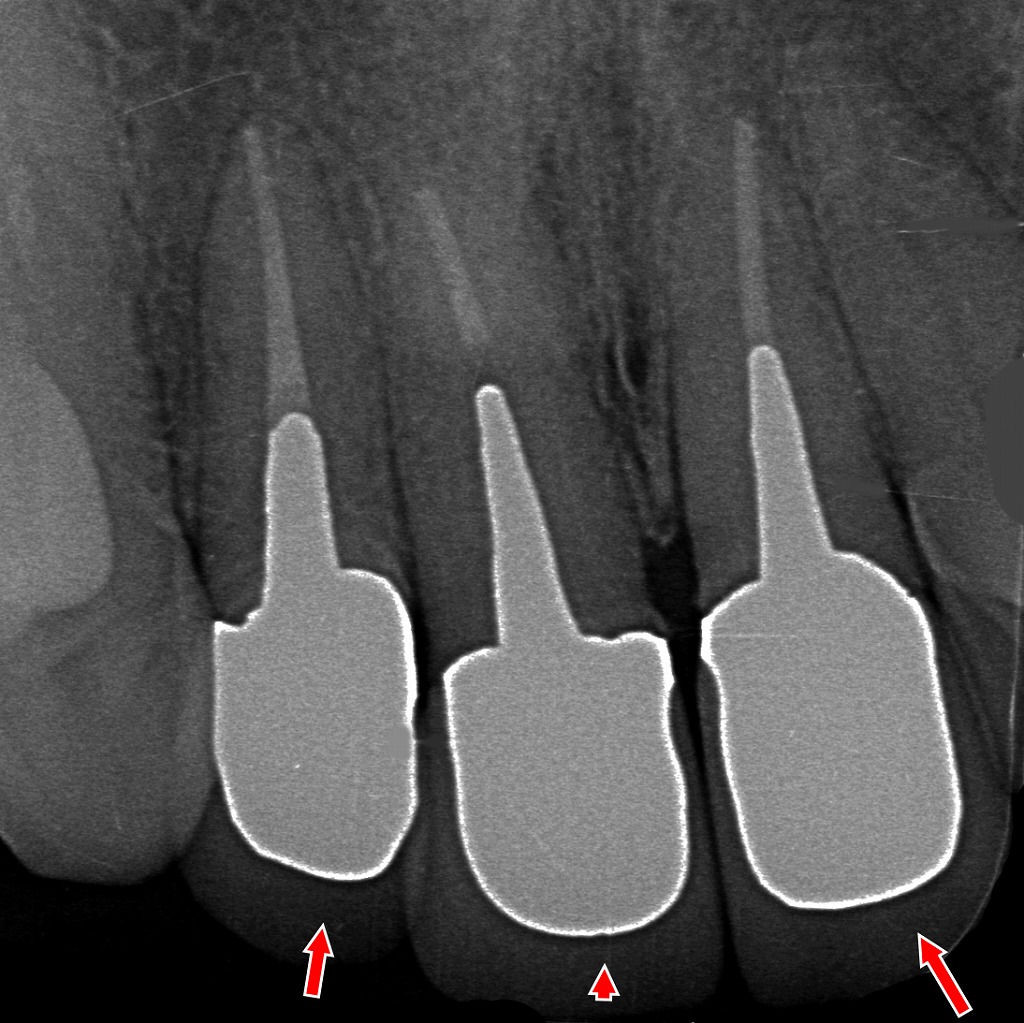 3本の前歯をメタルボンドクラウンで再作製し、安定した支台形態と良好な適合が確認できます。