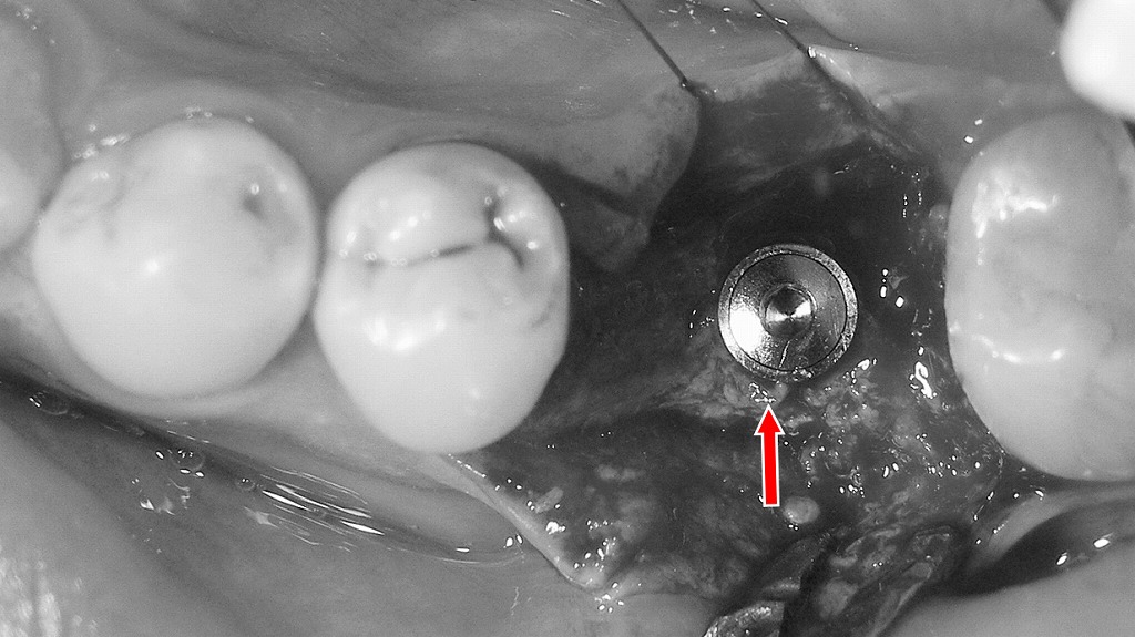 下顎6番欠損相当部へのインプラント埋入