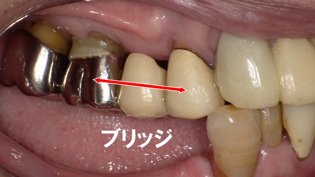 ４・５・６番ブリッジ