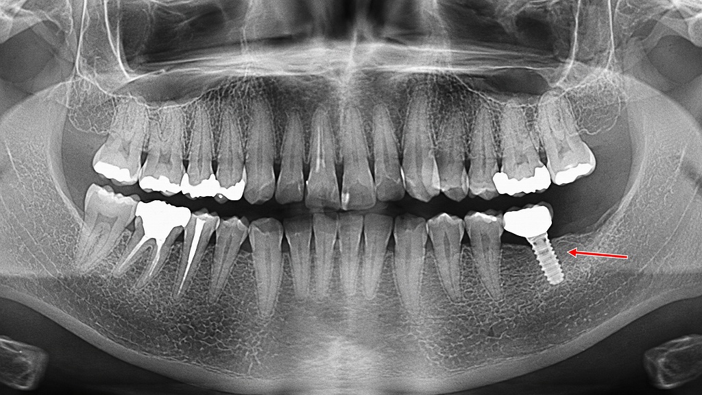 抜歯後の選択肢 ― インプラントによる機能回復