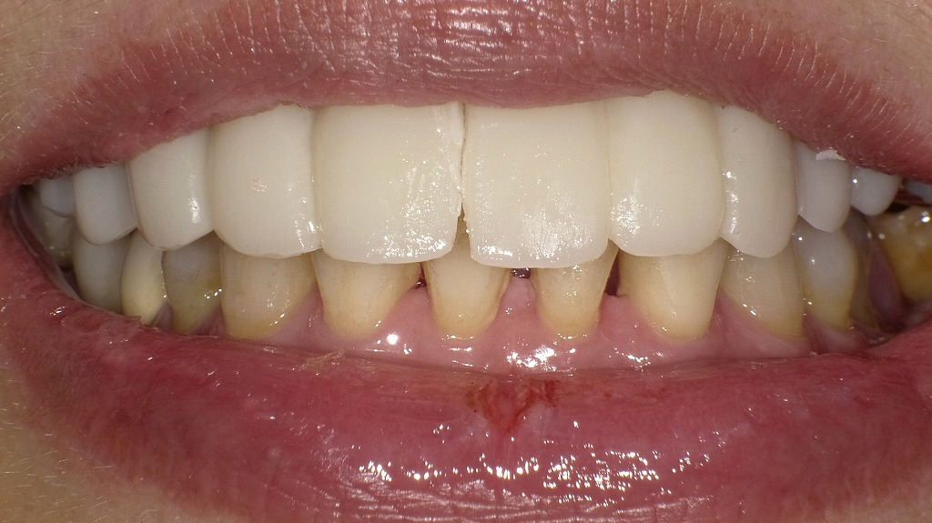 仮歯(プロビジョナルブリッジ)を装着