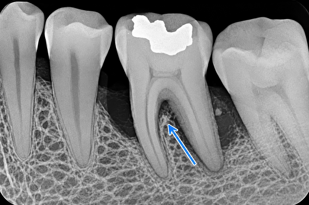 リンデの分類2度のレントゲン画像