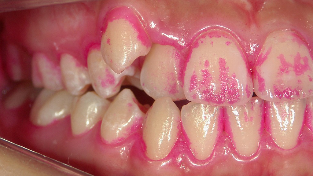 正しい歯磨きでここまで変わる！磨き残しの大幅改善