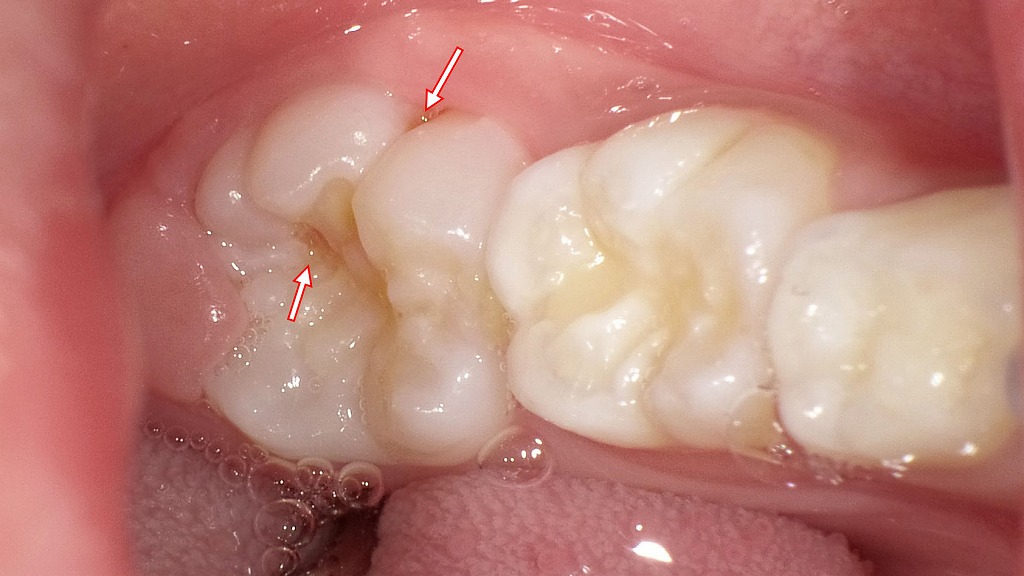 生えたての6歳臼歯にできた初期むし歯