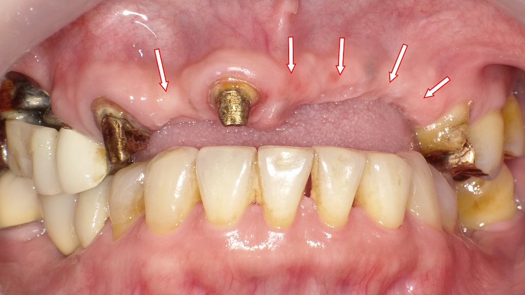 前歯のブリッジを除去