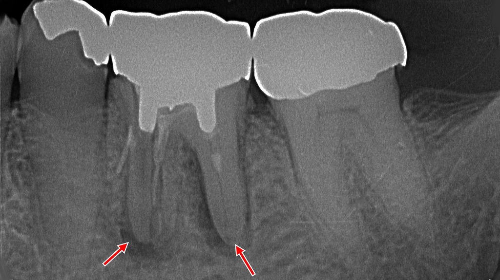 歯根破折のため抜歯