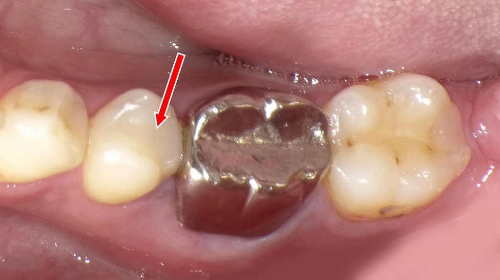 CAD/CAMインレーの症例