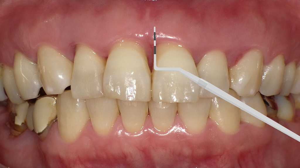 8mmの歯周ポケットが示す重度歯周病のサイン