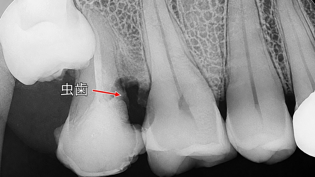 歯間ブラシが必要な理由|上顎7番・6番の歯間に生じた虫歯