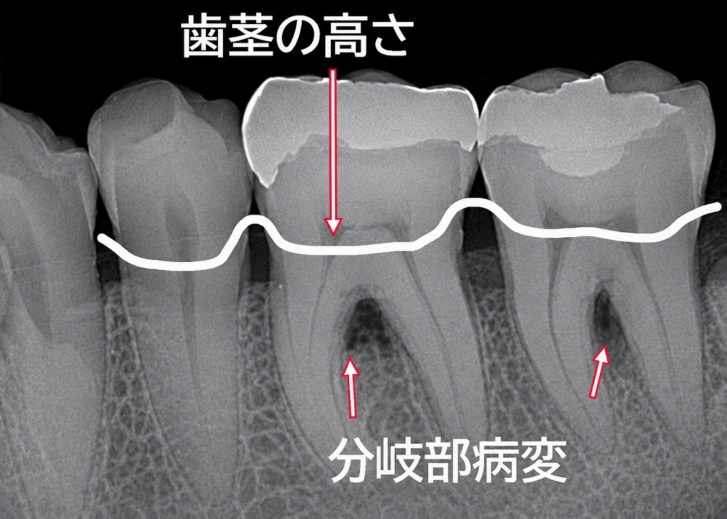 トンネリング(トンネル形成術)