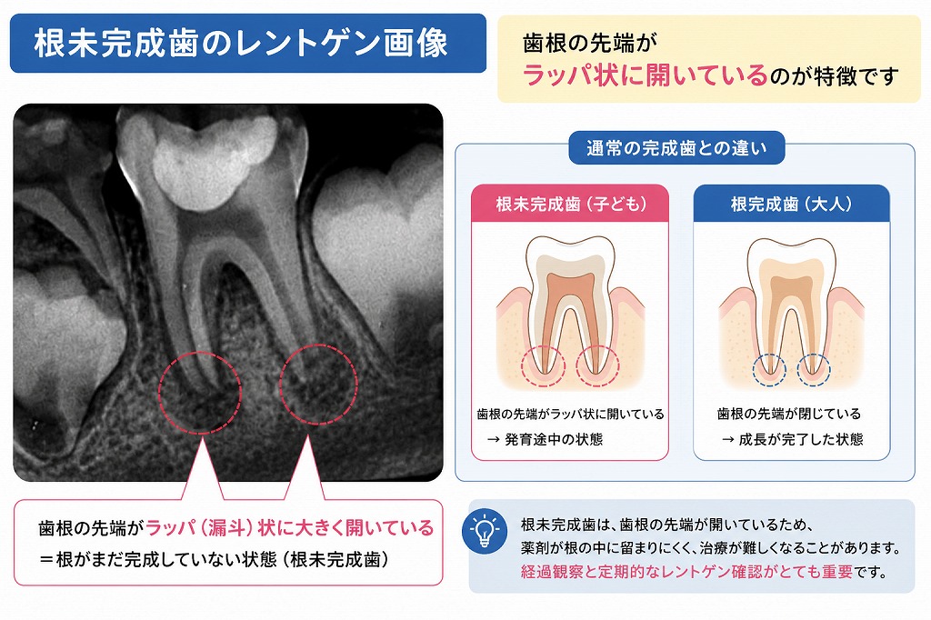 根未完成歯とは？
