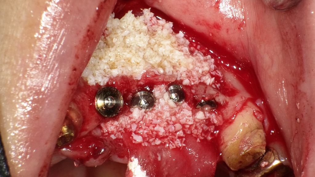 インプラント埋入と骨造成(GBR)