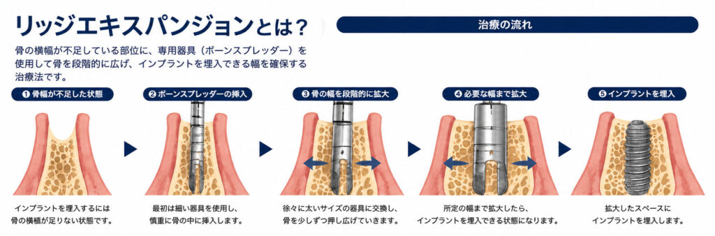 リッジエキスパンジョンとは？