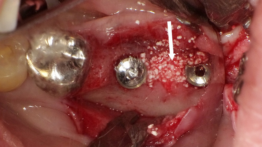 インプラント埋入とGBR