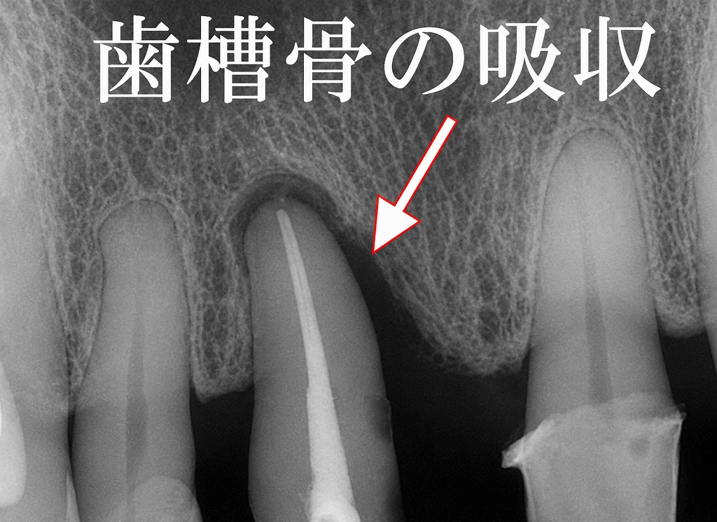 歯周ポケットが10ｍｍを超えている歯槽骨吸収