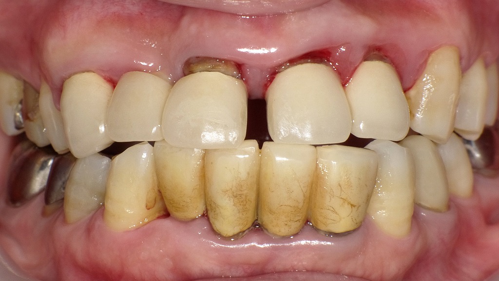 40代女性の歯周病症例