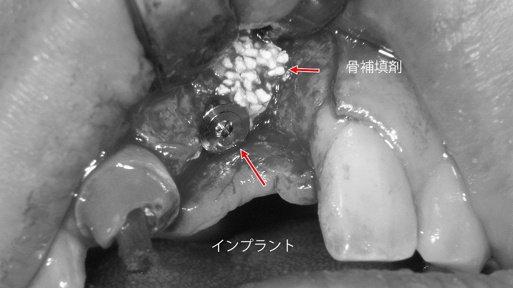 骨補填を併用したインプラント埋入