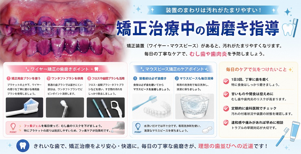 矯正治療中の歯磨き指導