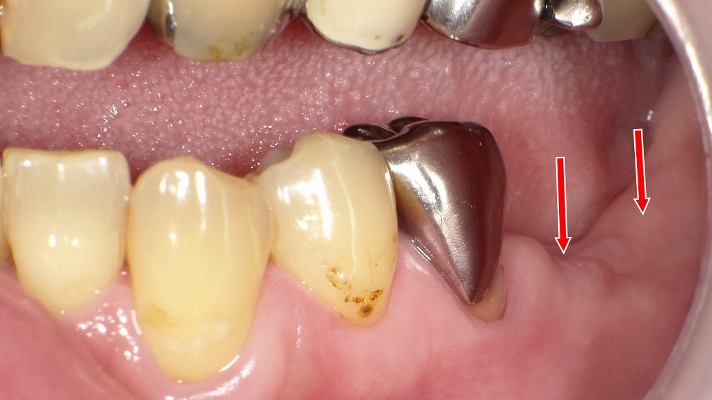 左下の6番・7番欠損症例