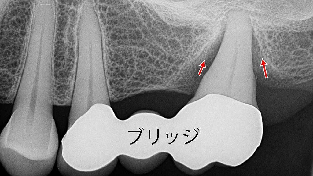 7番の重度歯周病で抜歯に至った症例