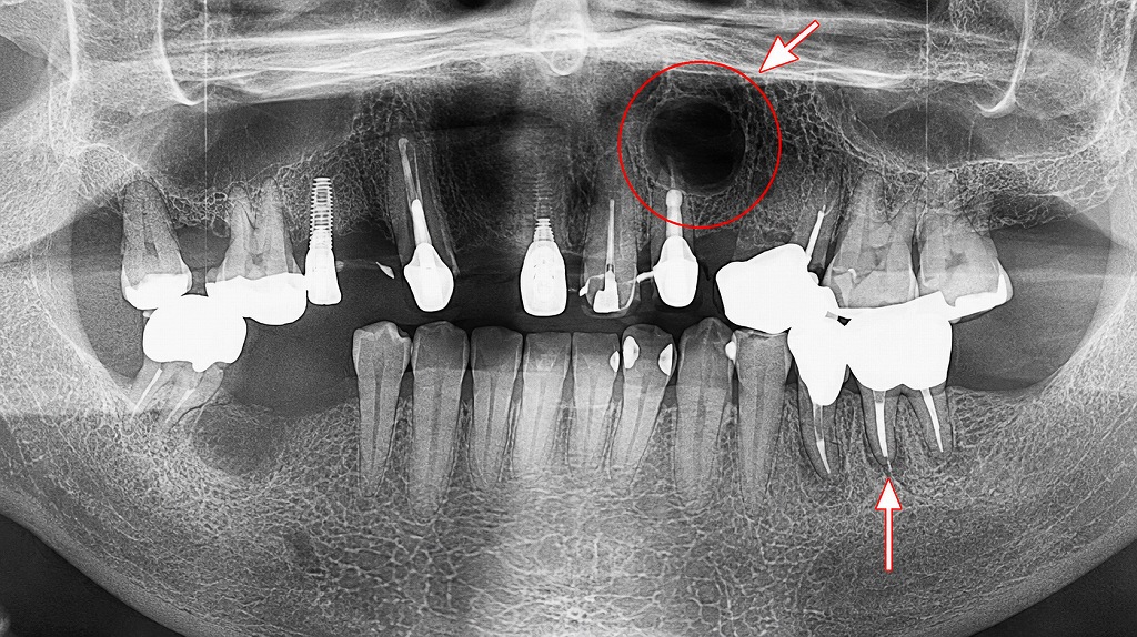 被せ物の根尖病巣（歯根嚢胞）の有無を確認：2番に大きな歯根嚢胞を認める
