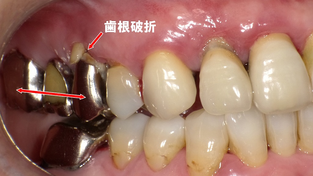 過重負担による歯根破折を起こした上顎5・6・7番ブリッジ症例