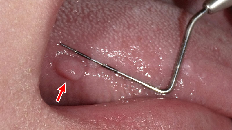 舌側にみられる口腔線維腫(良性腫瘍)