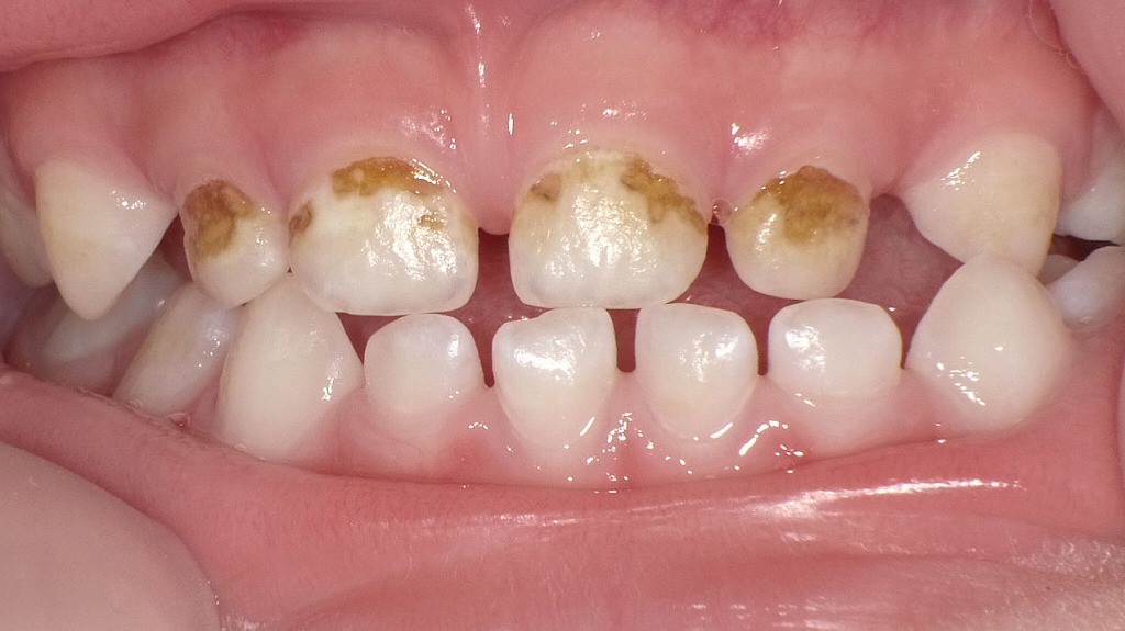 3歳児の前歯に認められる虫歯