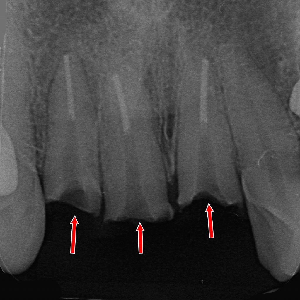 赤矢印は、折れたクラウンとメタルコアを除去した後に露出した歯根の状態を示しています。