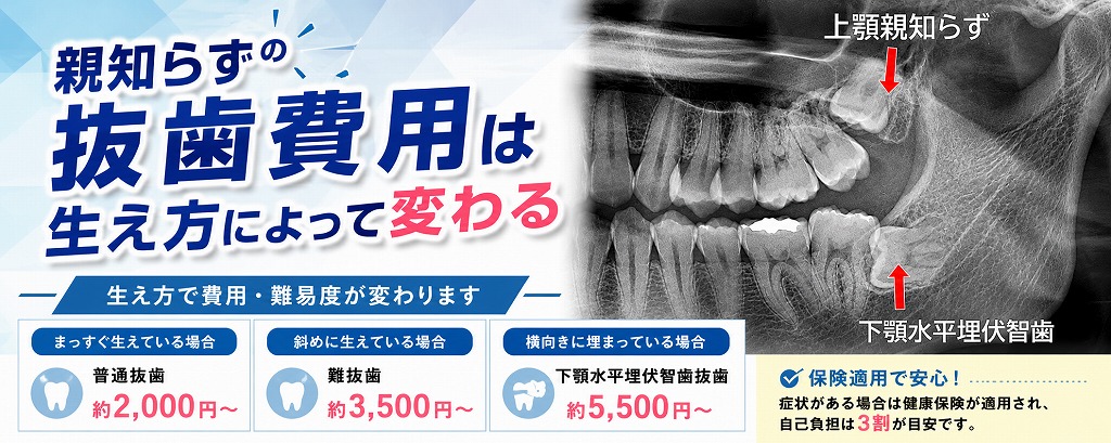 親知らずの抜歯費用は生え方によって変わる