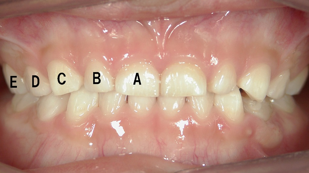 乳歯列：正面観